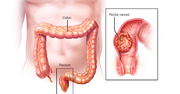 Know More Information about Rectum cancer