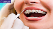 Dental braces price